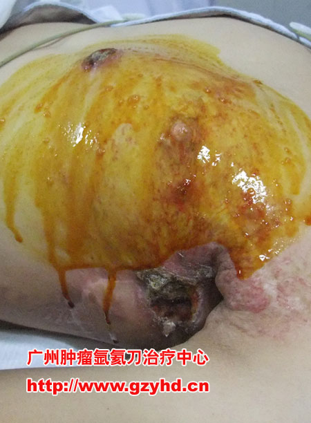 癌性溃疡的氩氦刀治疗:乳腺癌手术切除后复发,放疗无效