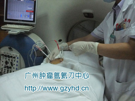 华南地区率先开展氩氦刀 化疗粒子(顺铂)治疗肺肿瘤